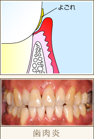 歯肉炎