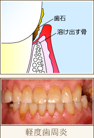 軽度歯周炎