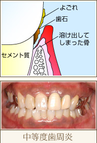中等度歯周炎