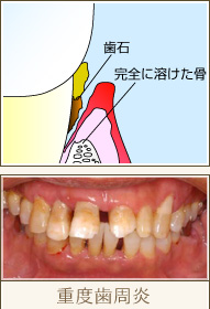 重度歯周炎